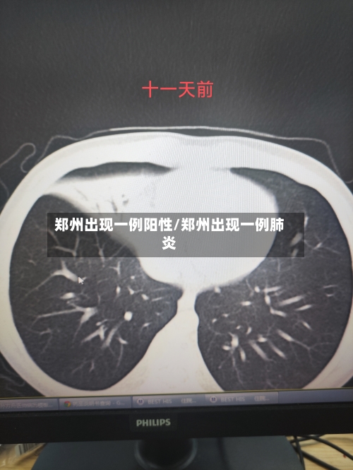 郑州出现一例阳性/郑州出现一例肺炎